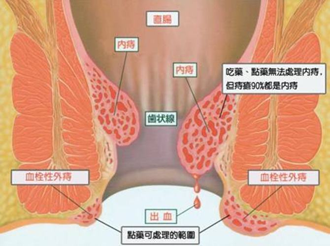 内痔