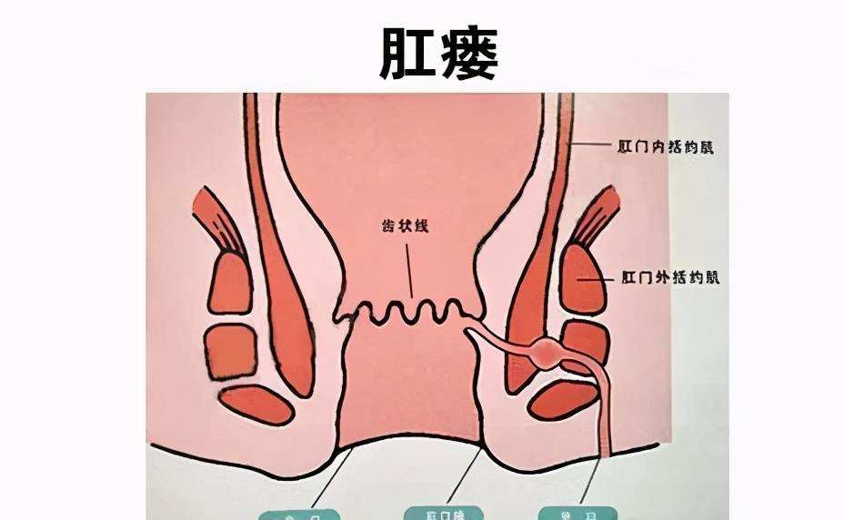 肛瘘